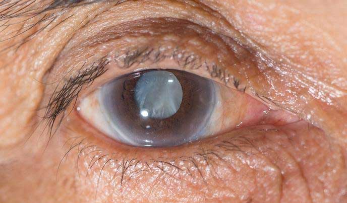 Eye examination for glaucoma risk and diagnosis