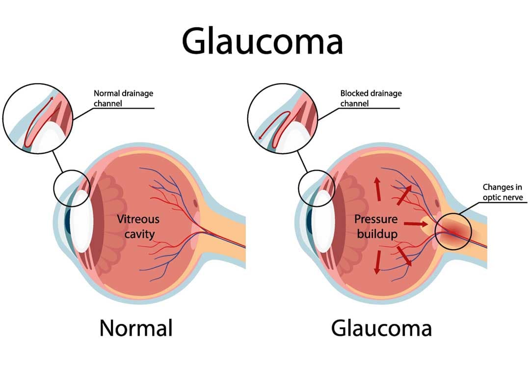 How blocked eye drainage can cause glaucoma