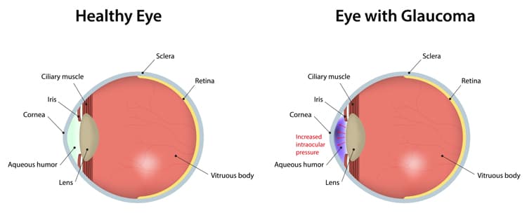 Healthy eye compared with an eye affected by glaucoma