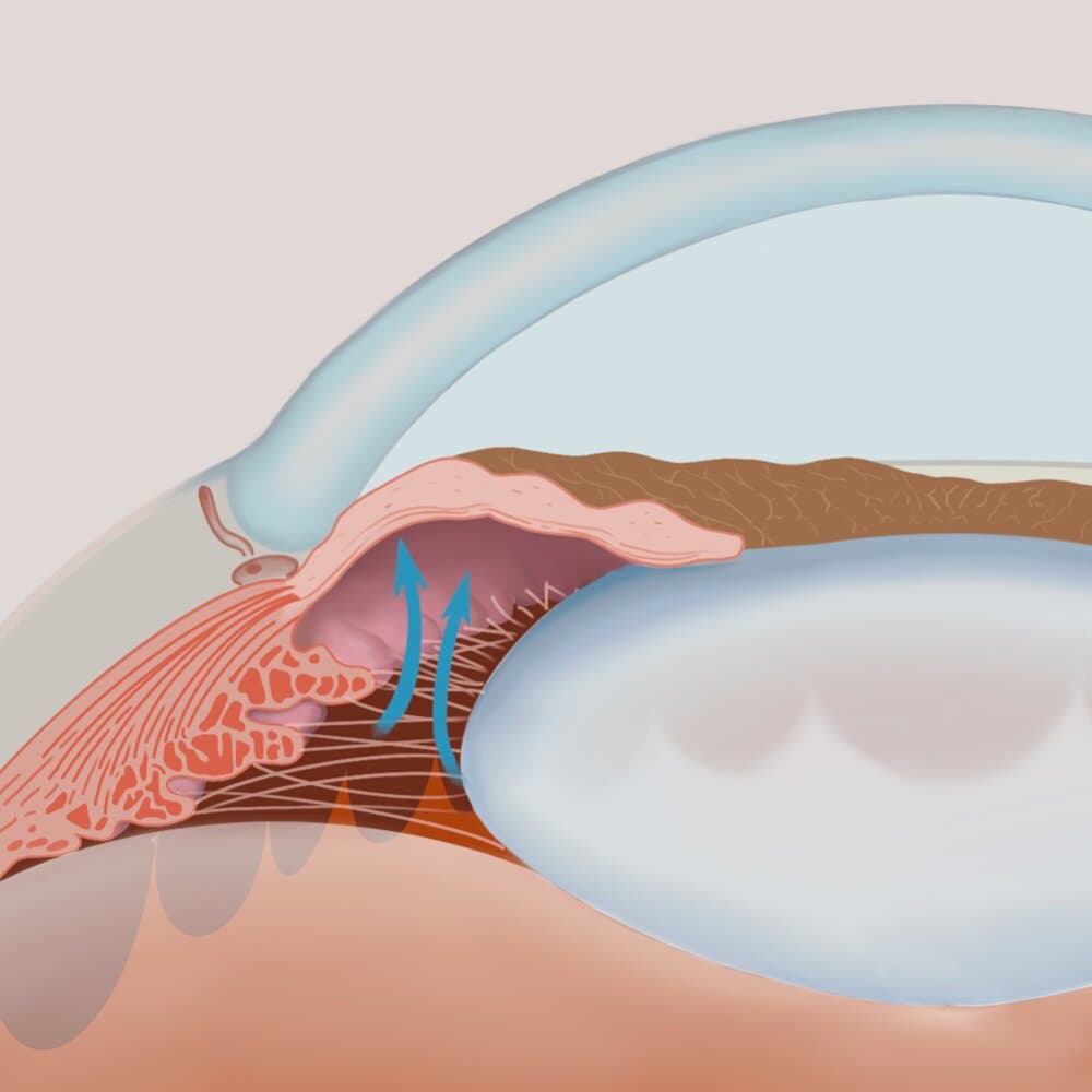 Angle-Closure Glaucoma