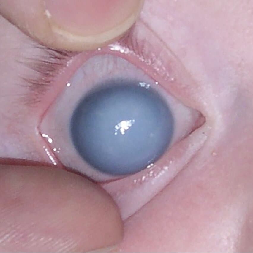 Congenital and Childhood Glaucoma
