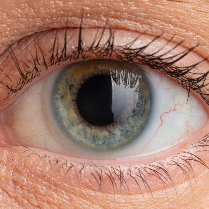 Neovascular Glaucoma