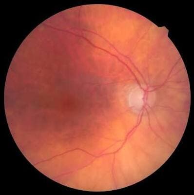 Normal-Tension Glaucoma