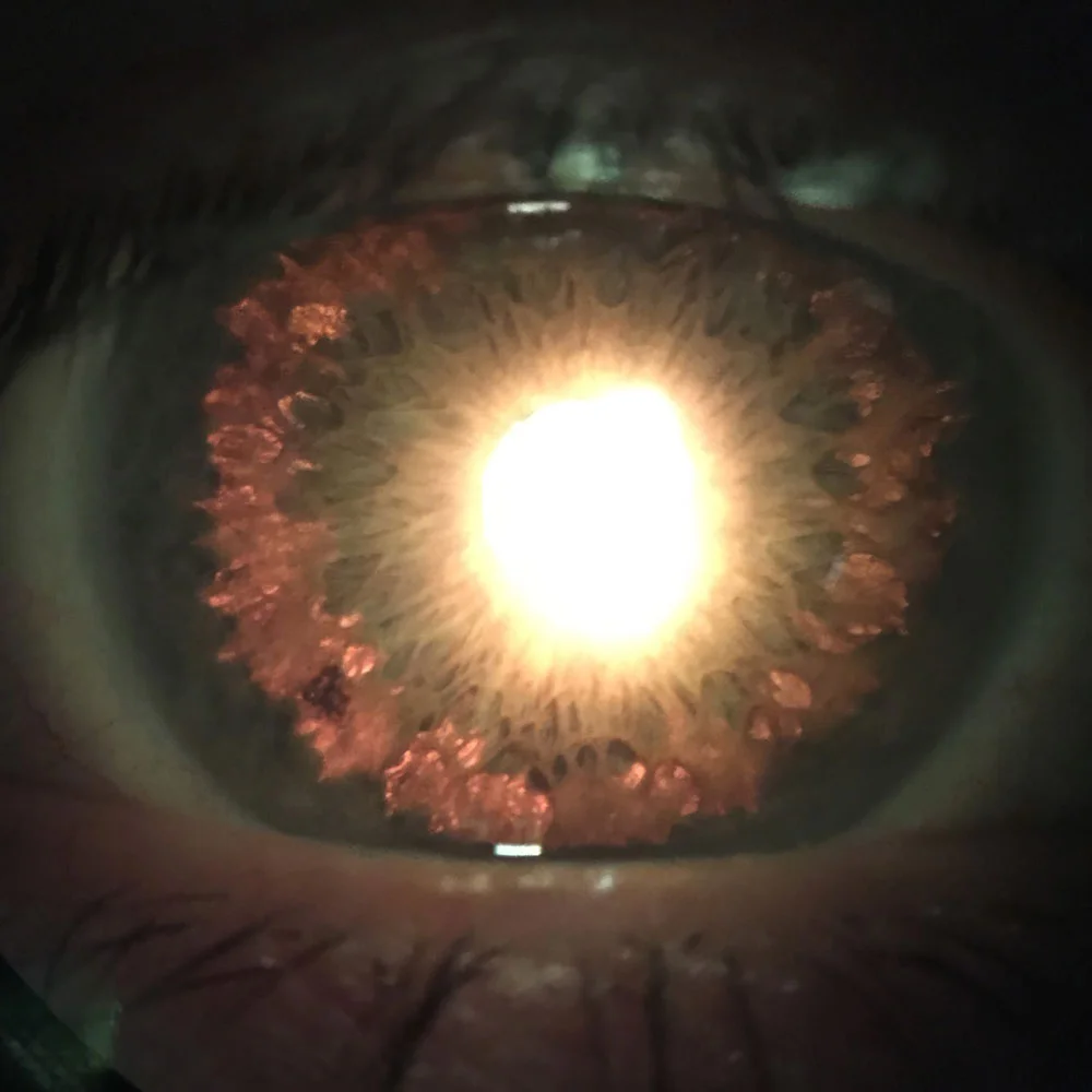 Pigmentary and Pseudoexfoliative Glaucoma