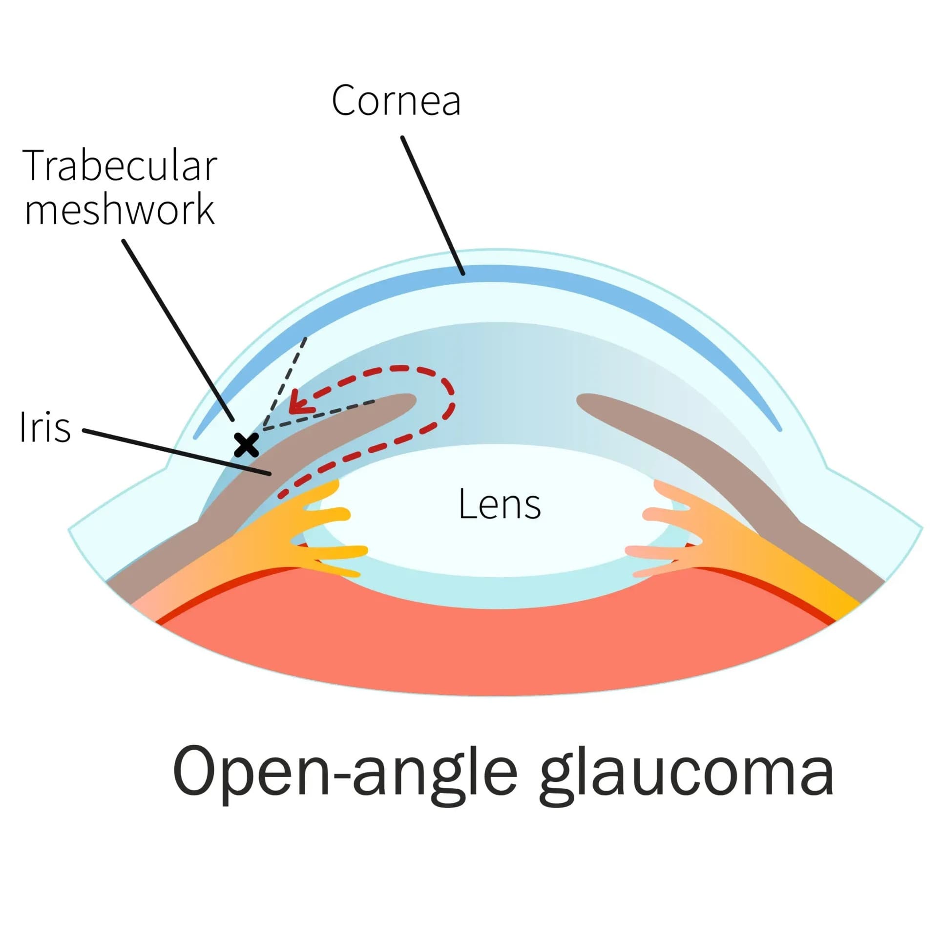 Primary Open-Angle Glaucoma