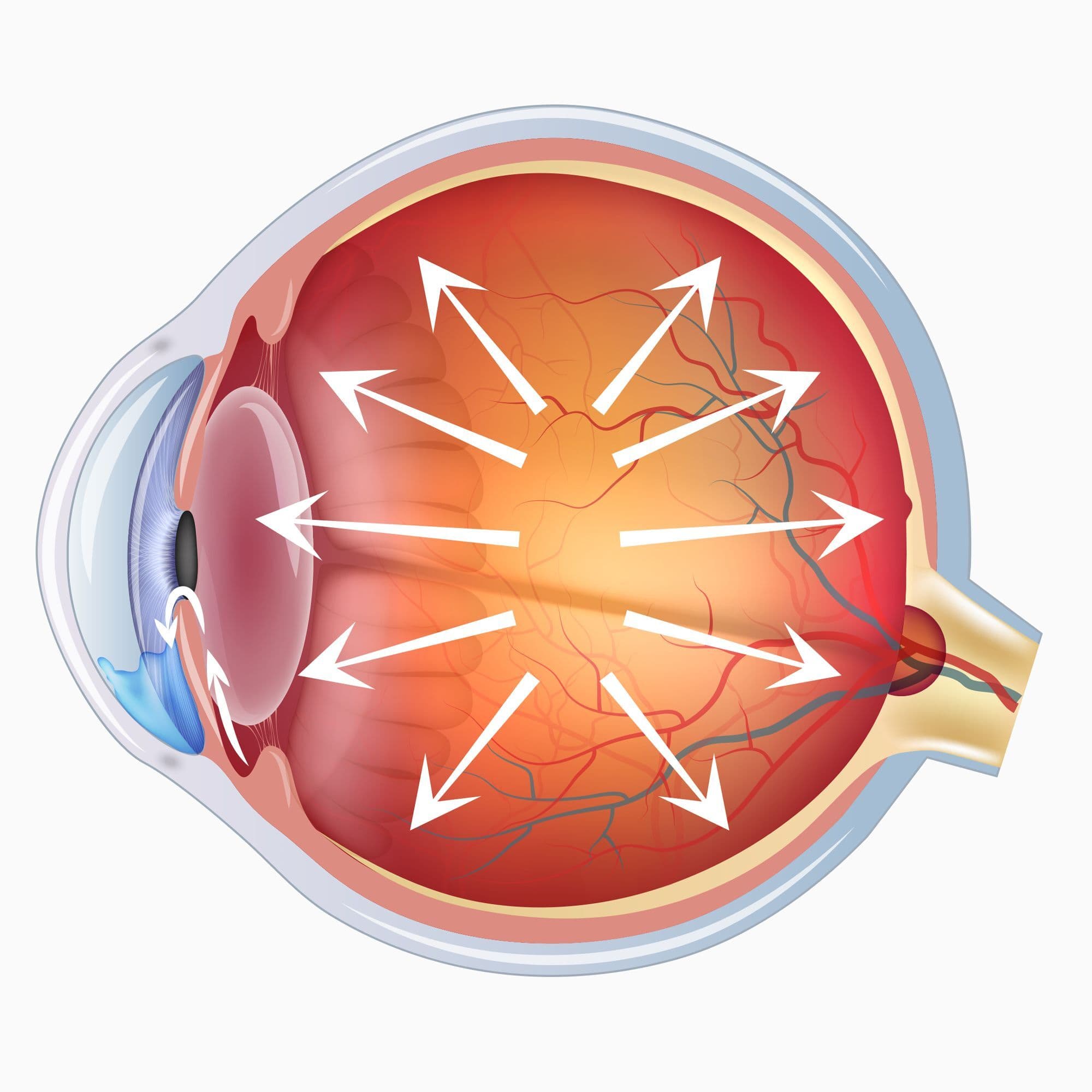 Secondary Glaucoma