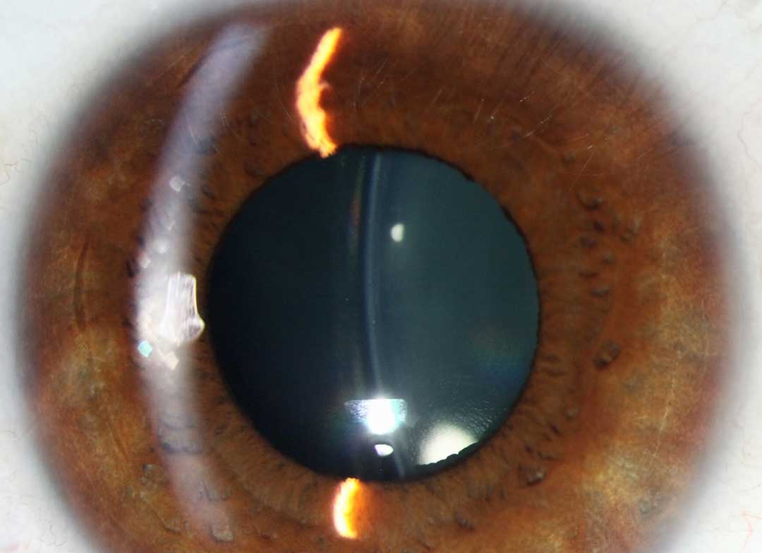 C3R corneal collagen cross-linking at Kenia Eye Hospital