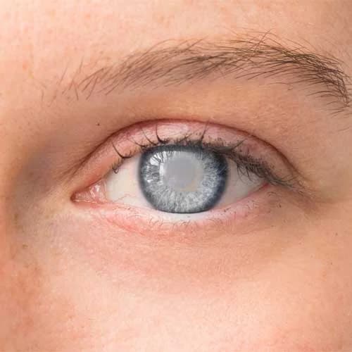 Cataract Surgery