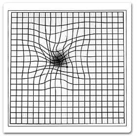 Amsler grid distortion example for age-related macular degeneration