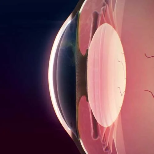 Cornea Treatment