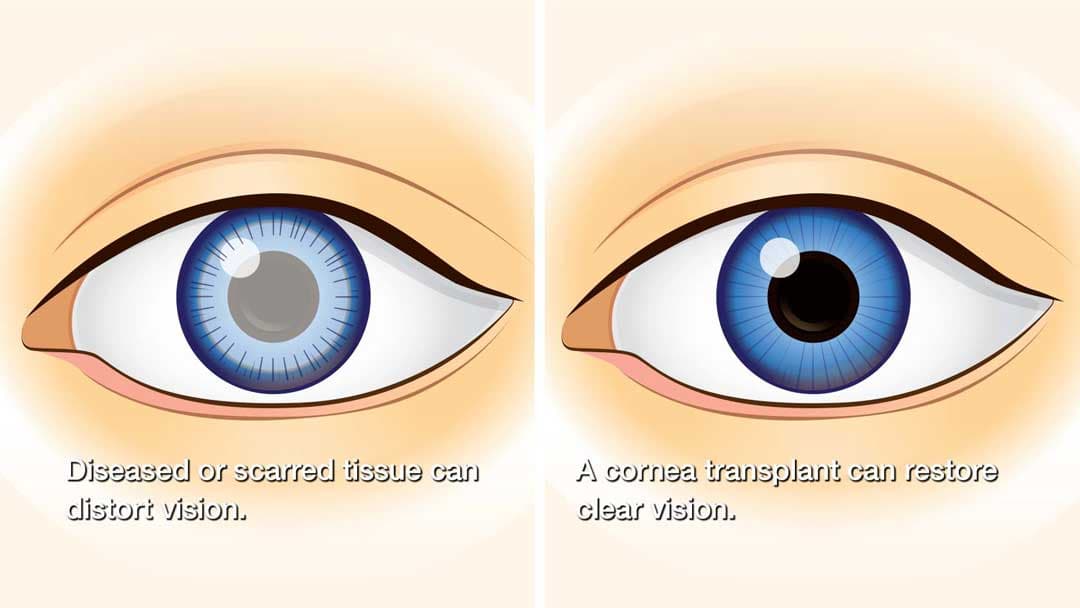 Cornea treatment and transplant care at Kenia Eye Hospital