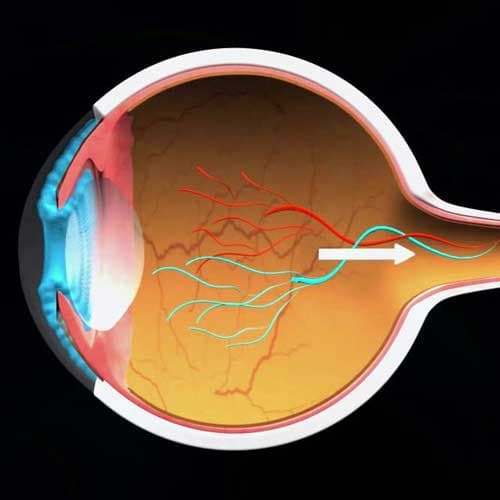 Glaucoma Clinic