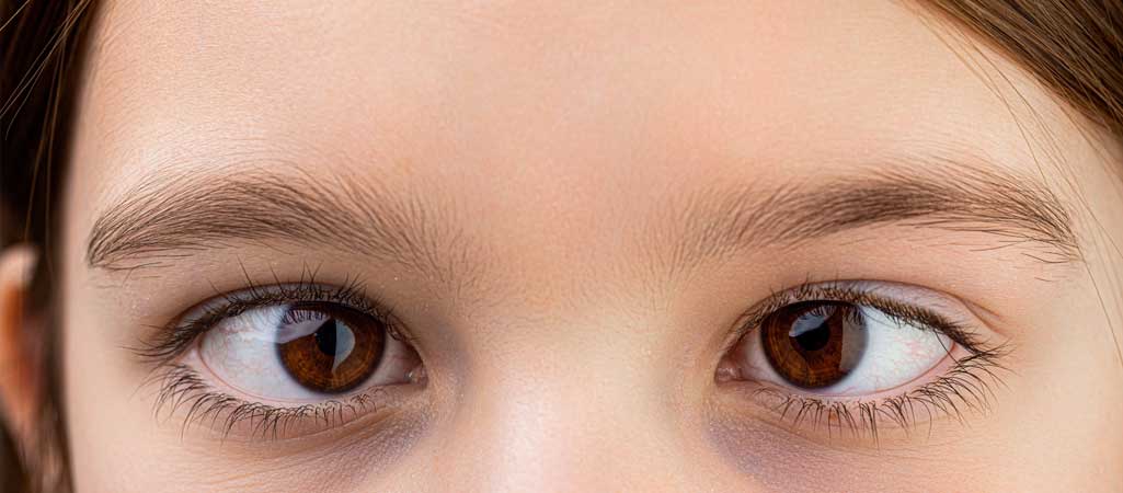 Squint Eye Treatment in