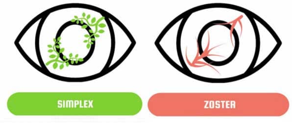Story of a banker affected by Herpes Zoster Ophthalmicus (HZO)
