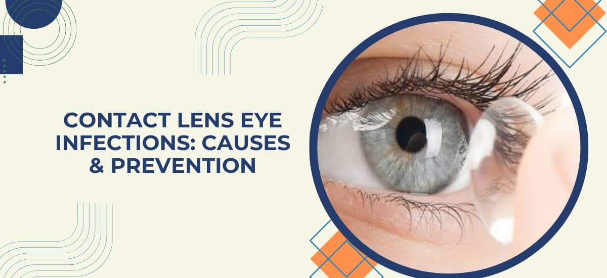 Contact Lens–Related Eye Infections: Prevention Guide