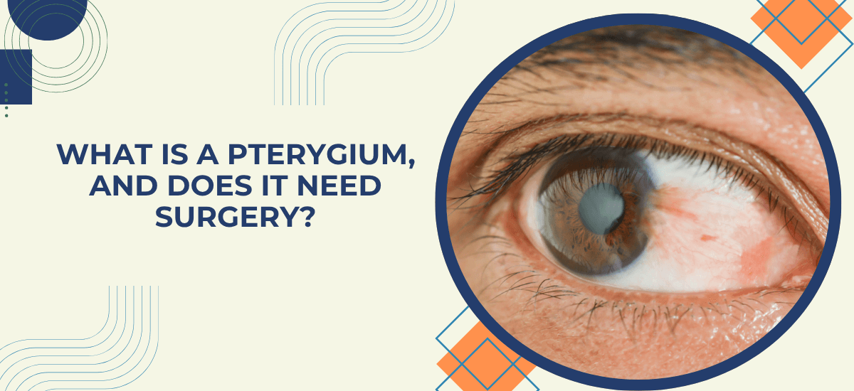 What Is a Pterygium (Surfer's Eye), and Does It Need Surgery?