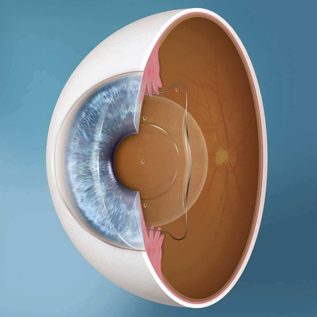 ICL vision correction at Kenia Eye Hospital