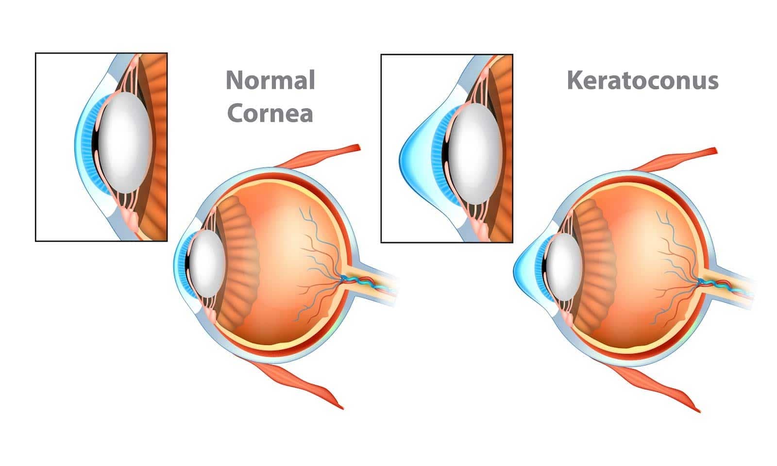 Keratoconus treatment at Kenia Eye Hospital