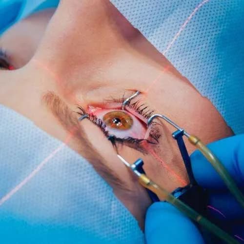 LASIK Vision Correction