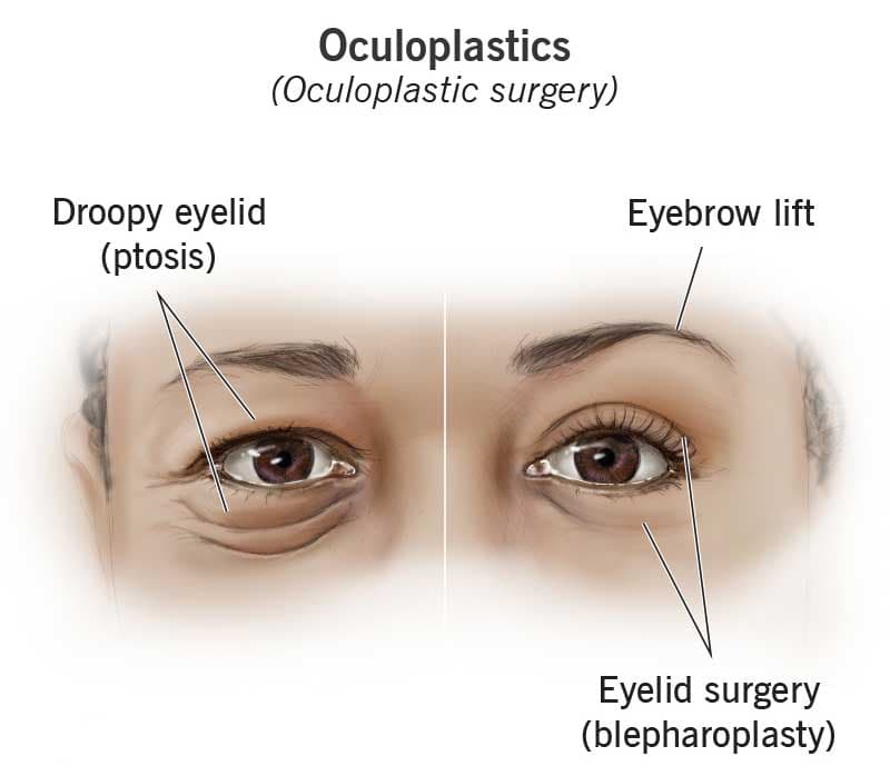 Oculoplastic surgery at Kenia Eye Hospital
