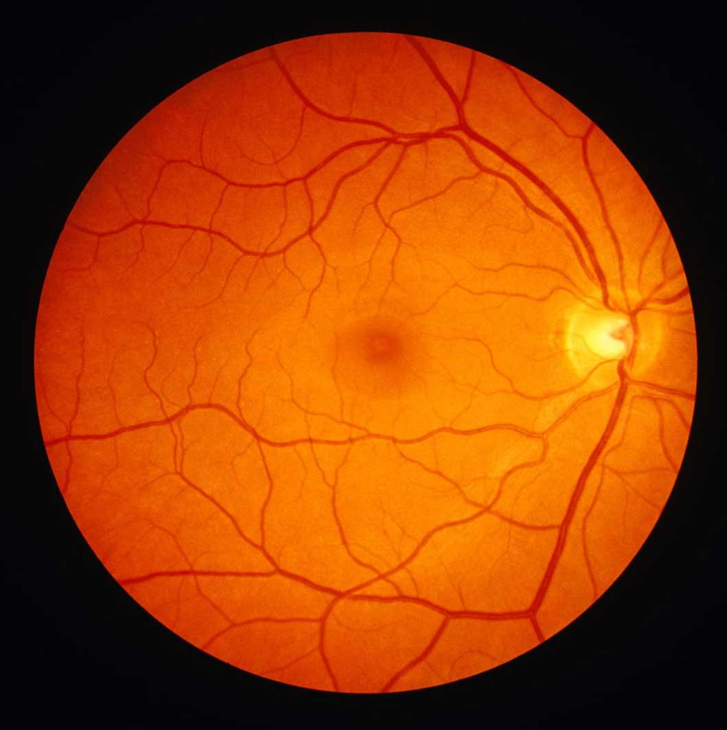 Retina clinic at Kenia Eye Hospital