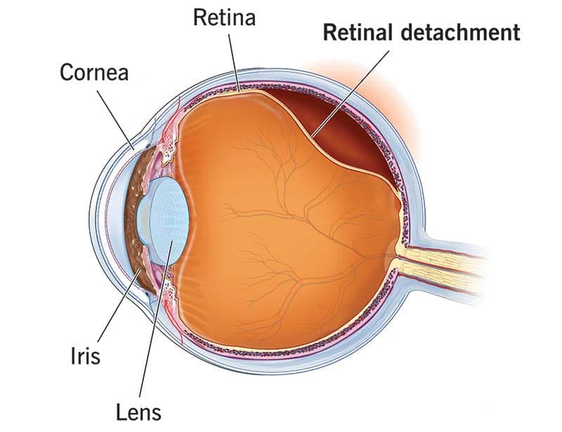 Retinal detachment care at Kenia Eye Hospital