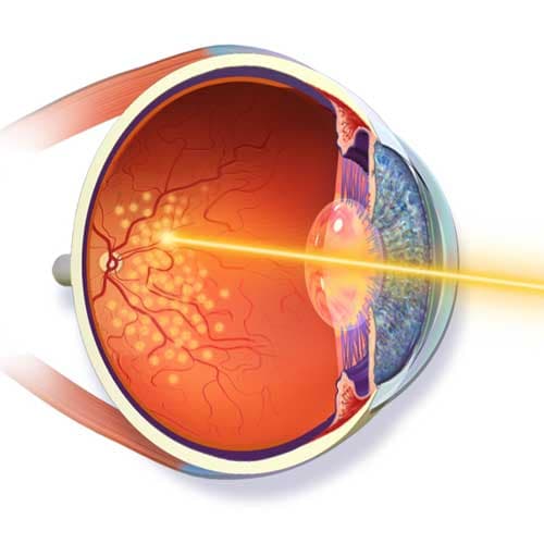 Retinal Laser