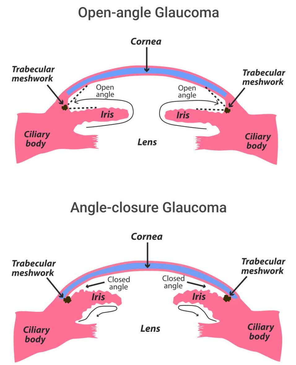 Types of glaucoma explained at Kenia Eye Hospital