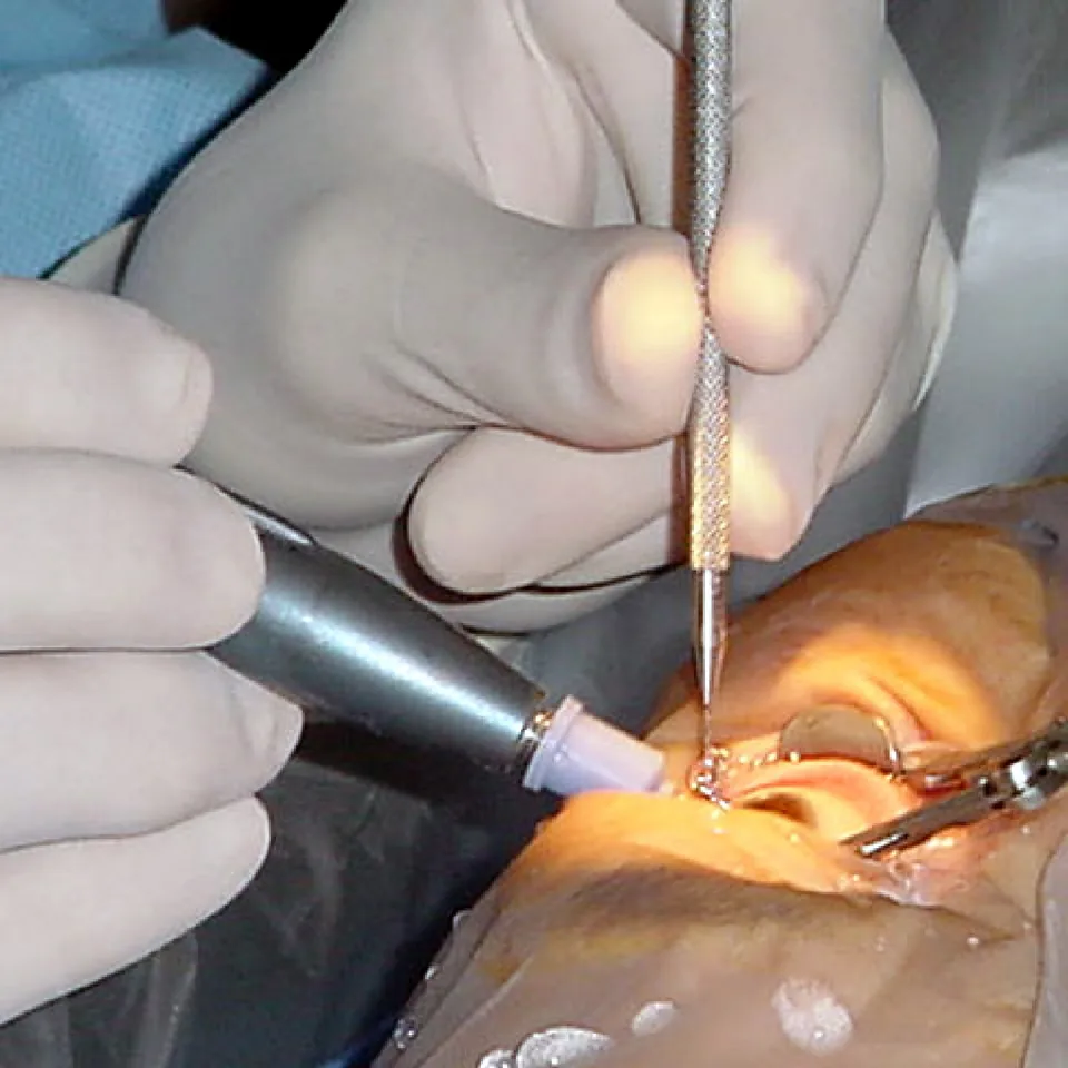 Phacoemulsification (MICS)