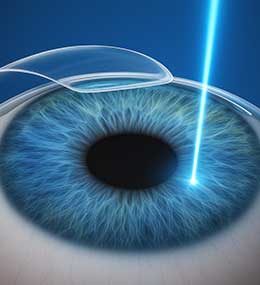 Bladeless Femto LASIK