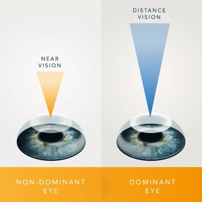 Monovision LASIK