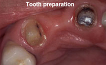 dental bridge front teeth