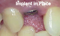 all on 4 dental implants