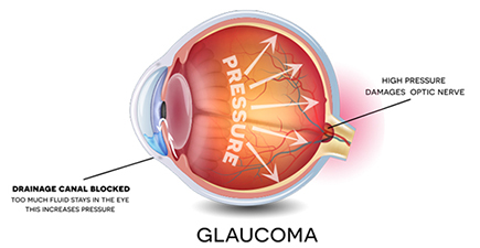what is glaucoma of the eye