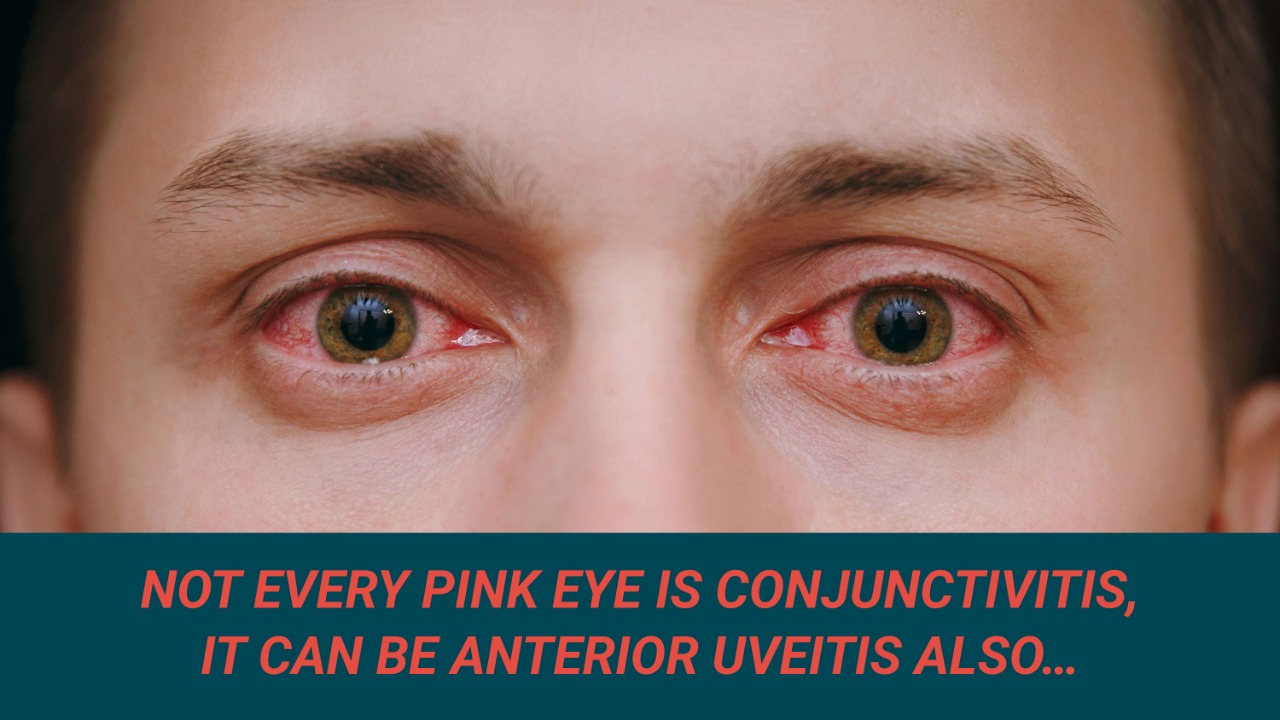NOT EVERY PINK EYE IS CONJUNCTIVITIS, IT CAN BE ANTERIOR UVEITIS ALSO