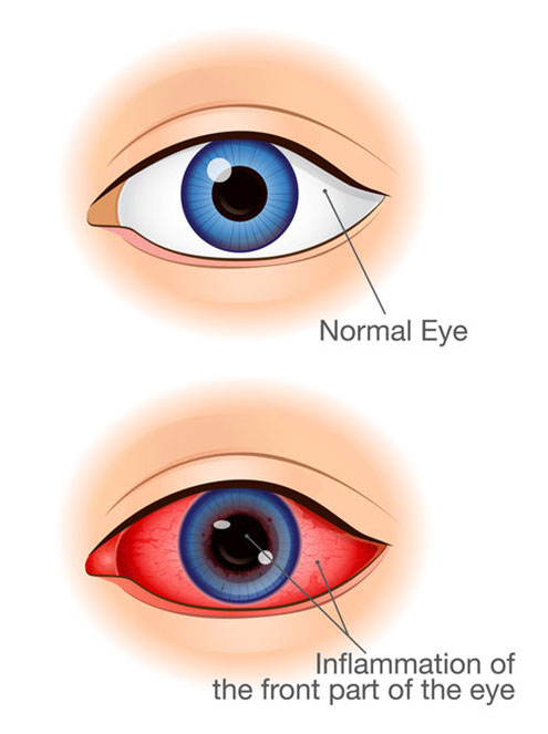 anterior uveitis