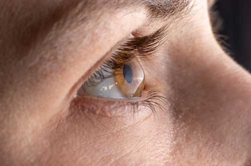 Image depicting PRK laser eye surgery procedure
