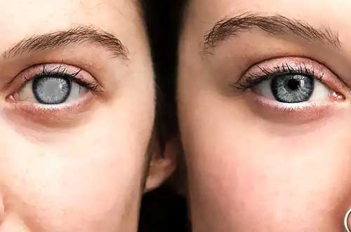 Image illustrating cataract-affected eye and treatment concept