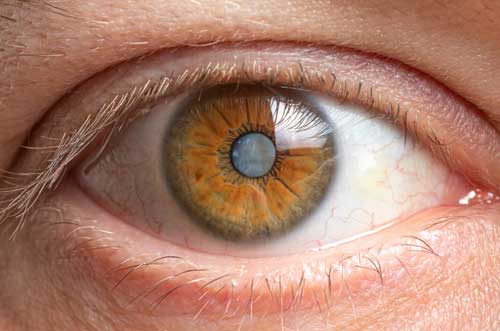 Visual showing cataract lens opacity and surgical correction