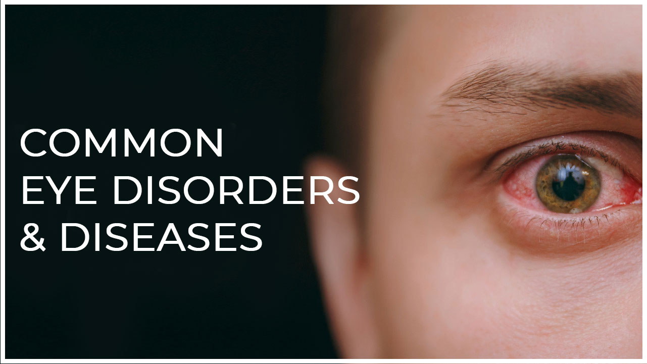 Common Eye Disorders & Diseases