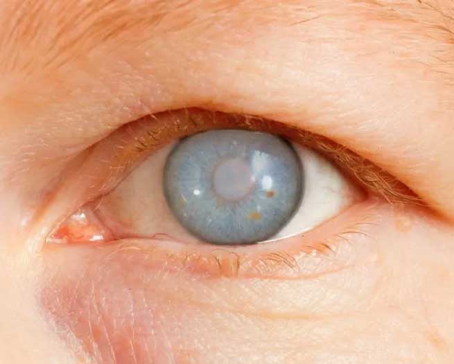 Image showing types and effects of frequent eye health issues