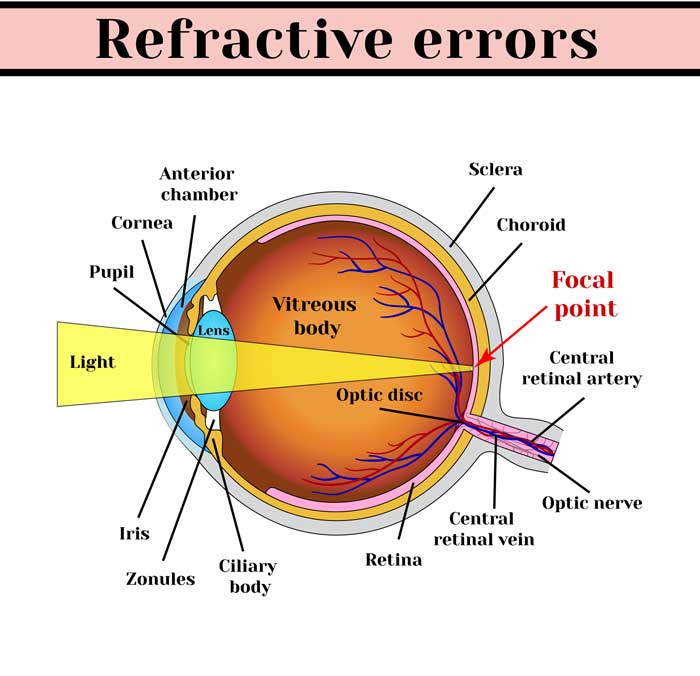 Graphic illustrating various common eye disorders and conditions