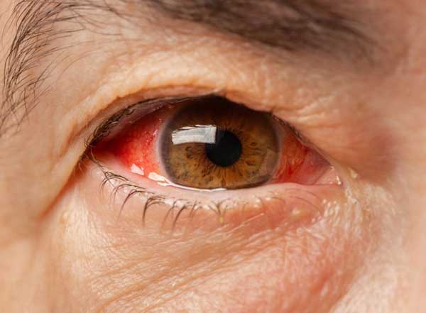 Image explaining symptoms and causes of pink eye (conjunctivitis)