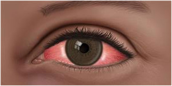 Conjunctivitis