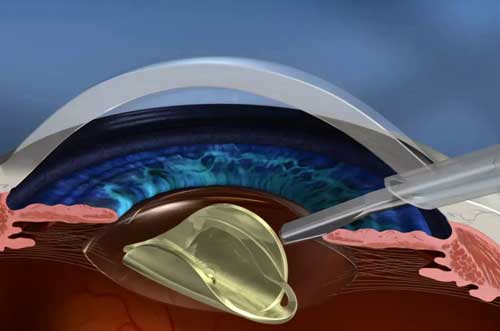 Visual representation of laser-assisted eye surgery procedure