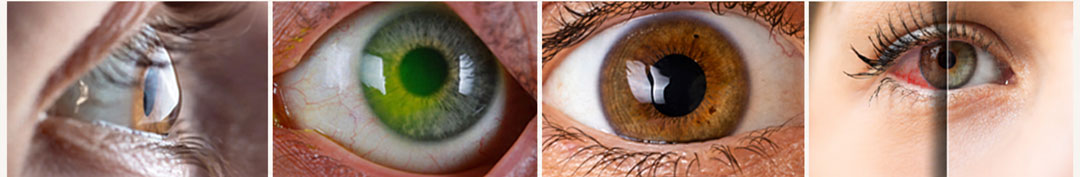Detailed visual explaining flapless eye surgery procedure at Kenia Eye Hospital