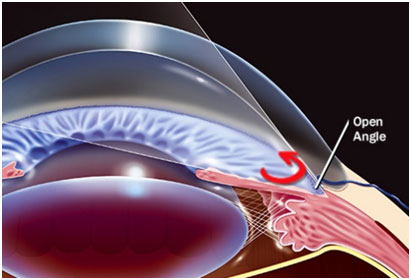 glaucoma clinic
