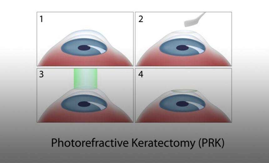 Comparison image illustrating differences between PRK and LASIK eye surgeries