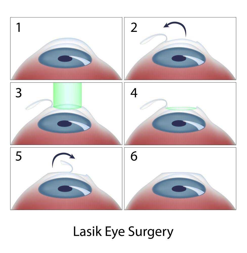 Visual explaining key distinctions between PRK and LASIK vision correction procedures