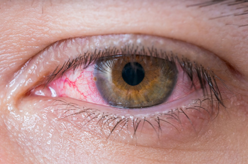 Visual highlighting surgical techniques for vision correction in Kenia Eye Hospital blog article